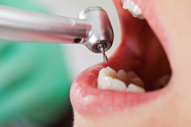 Best Knocked-Out Tooth (Avulsed Tooth) Treatment in Industry, PA